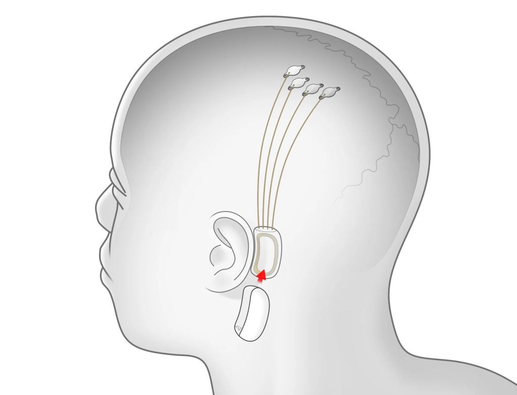 Neuralink Achieves Milestone with First Human Brain-Chip Implant